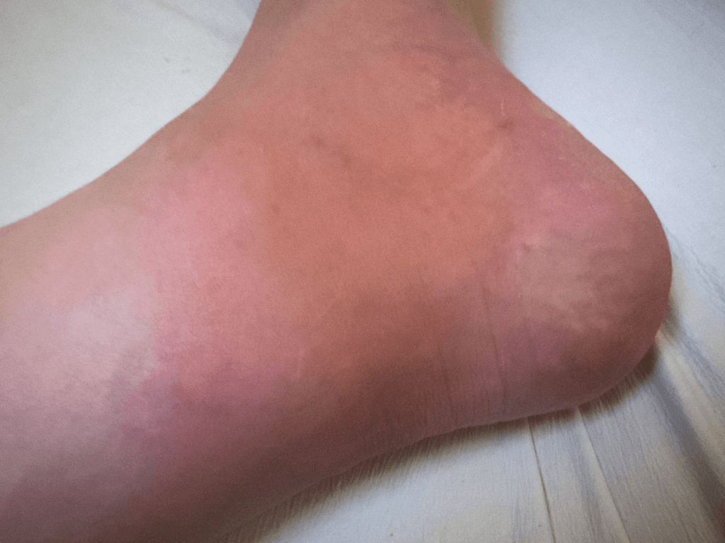 ブユ（ブヨ・ブト）刺され