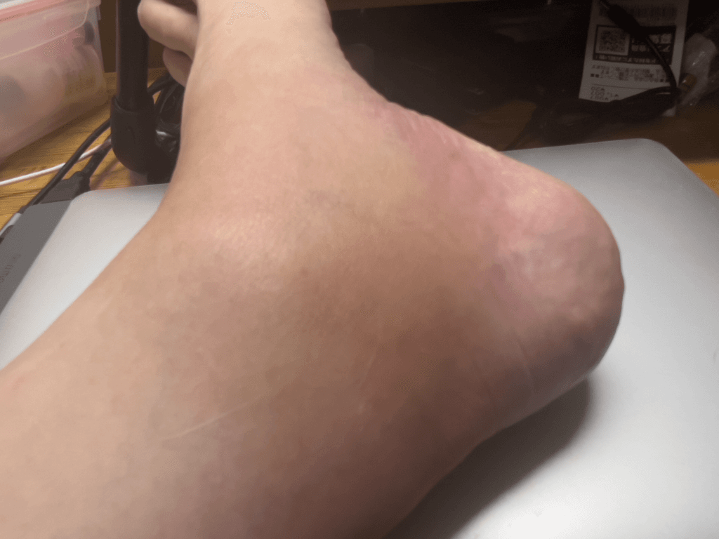 ブユ（ブヨ・ブト）刺され