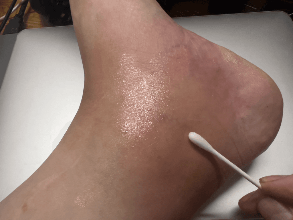 ブユ（ブヨ・ブト）刺され