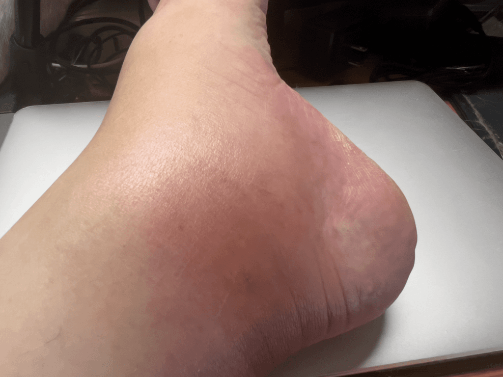 ブユ（ブヨ・ブト）刺され