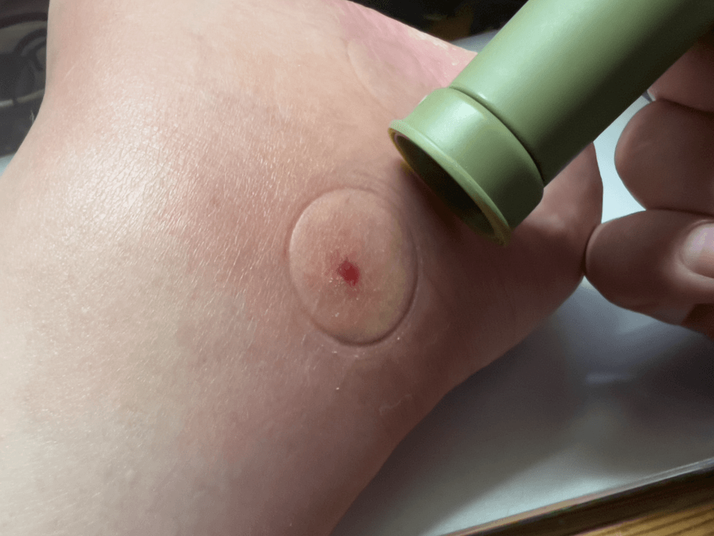 ブユ（ブヨ・ブト）刺され